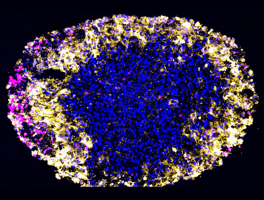 Patient-derived glioblastoma organoid treated with dual-target CAR-T cells.
